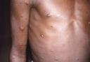 Generic picture of lesions caused by monkeypox. Picture: CDC/AP.