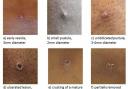 The stages of monkeypox. Picture: The UK Health Security Agency