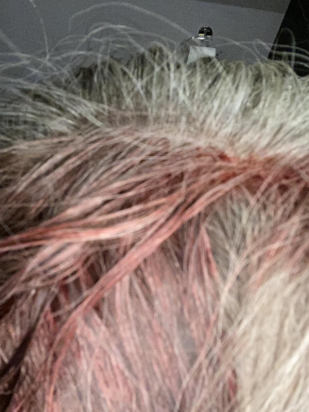 Watford Observer: Suzanne Powell shared this photo of her head with blood on it after she was hit by a drill. She says she doesn't know how the drill fell from the roof