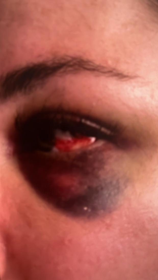 Watford Observer: The victim's eye after allegedly being punched unconscious. 
