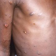 Generic picture of lesions caused by monkeypox. Picture: CDC/AP.