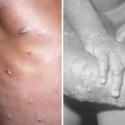 Generic monkeypox pictures. Credit: PA/CDC/AP.