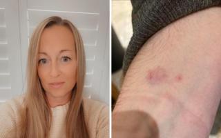 Kelly Currie (left) thinks the spiking figures are higher but people are to scared to come forward. Right: The marks on her son's arm after the alleged incident in November 2021.